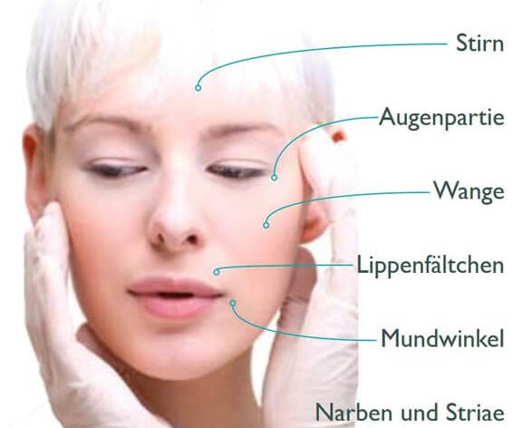 Vorteile Microneedling, Ästhetisch-Plastische Chirurgie in Trier, Dr. Arnold, Momartis