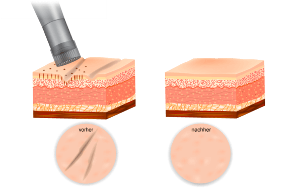 Vorher-Nachher Microneedling, Ästhetisch-Plastische Chirurgie in Trier, Dr. Arnold, Momartis