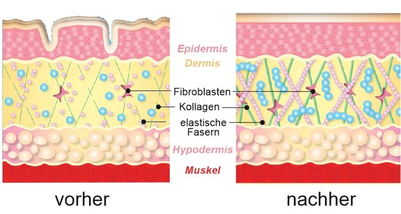 Vorher-Nachher Radiofrequenztherapie, Ästhetisch-Plastische Chirurgie in Trier, Dr. Arnold, Momartis