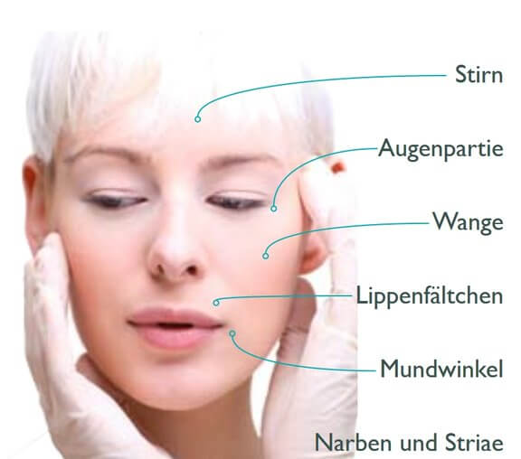 Vorteile Microneedling, Ästhetisch-Plastische Chirurgie in Trier, Dr. Arnold, Momartis